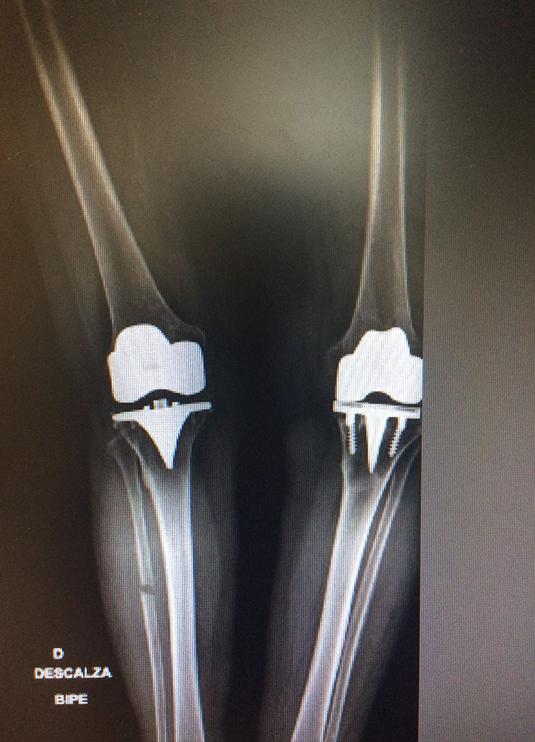 Cirugia de Rodilla