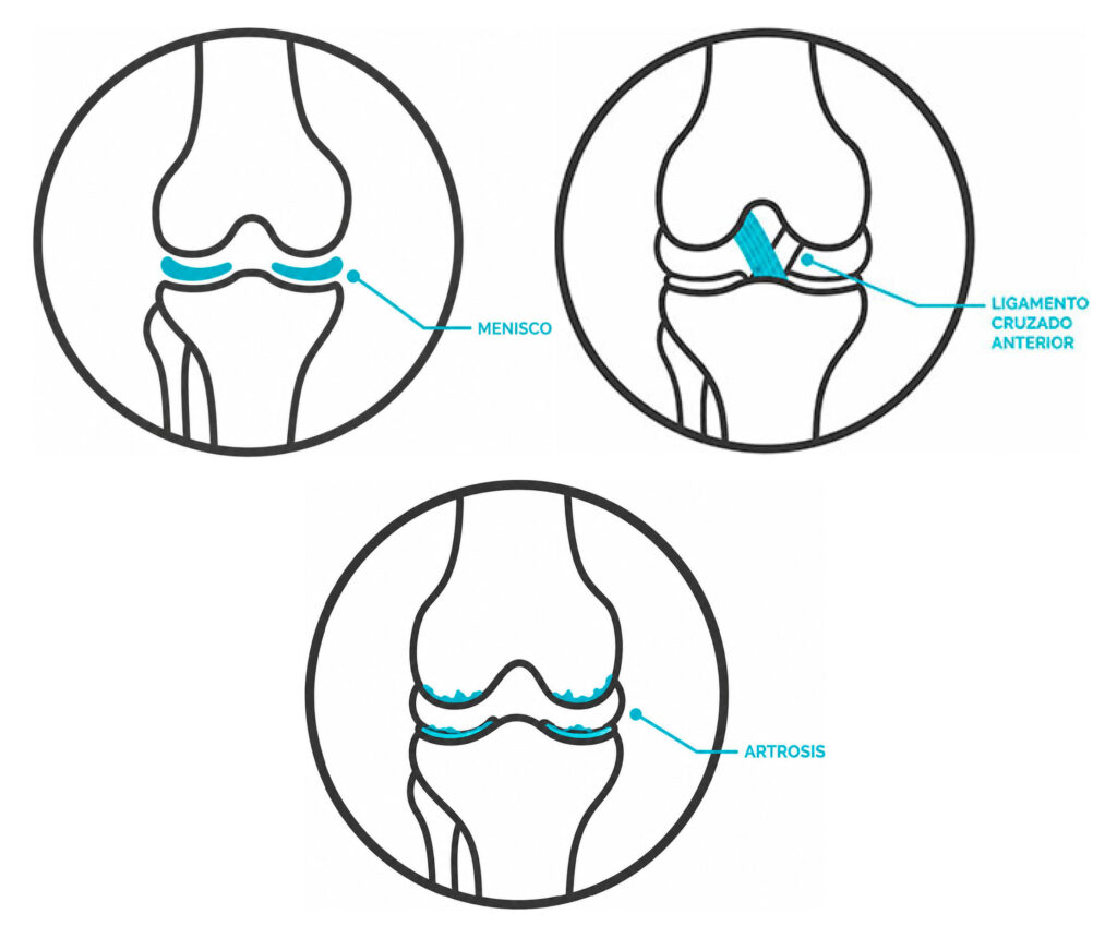 Patologias de la Rodilla